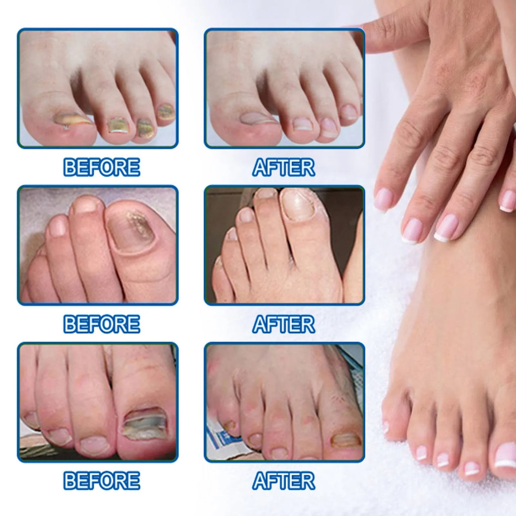 Box of 32 nail repair adhesive bandages with natural extracts for damaged fingernails and toenails