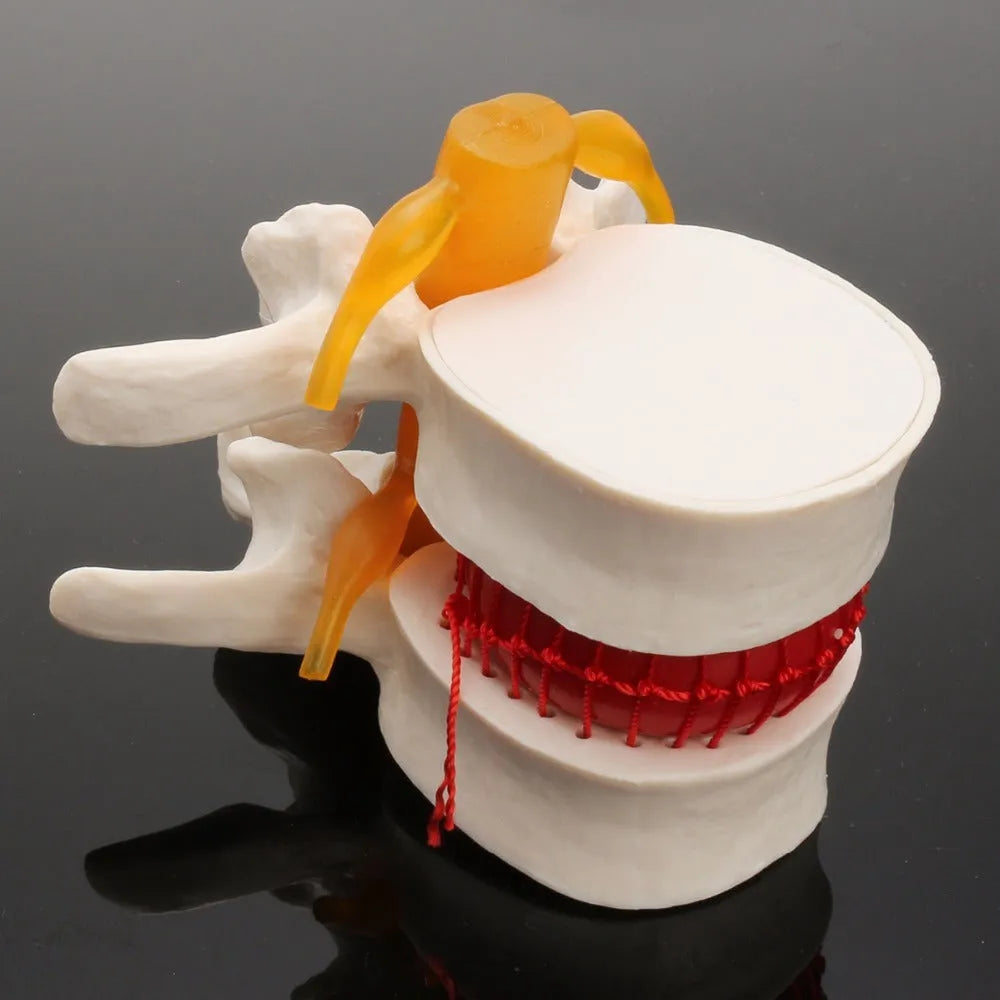 White PVC anatomical model of a lumbar spinal segment showing a herniated intervertebral disc.