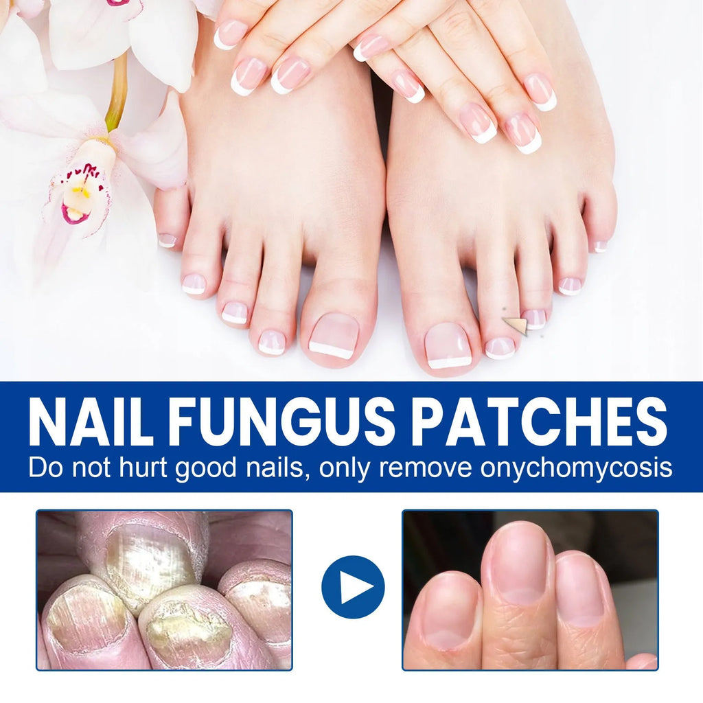 Box of 32 nail repair adhesive bandages with natural extracts for damaged fingernails and toenails