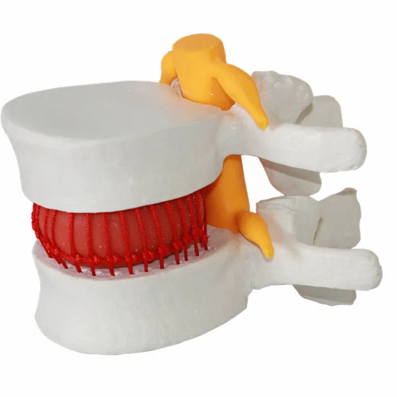 White PVC anatomical model of a lumbar spinal segment showing a herniated intervertebral disc.