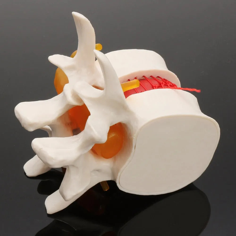 White PVC anatomical model of a lumbar spinal segment showing a herniated intervertebral disc.