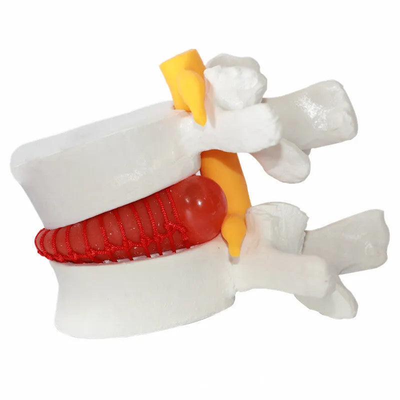 White PVC anatomical model of a lumbar spinal segment showing a herniated intervertebral disc.