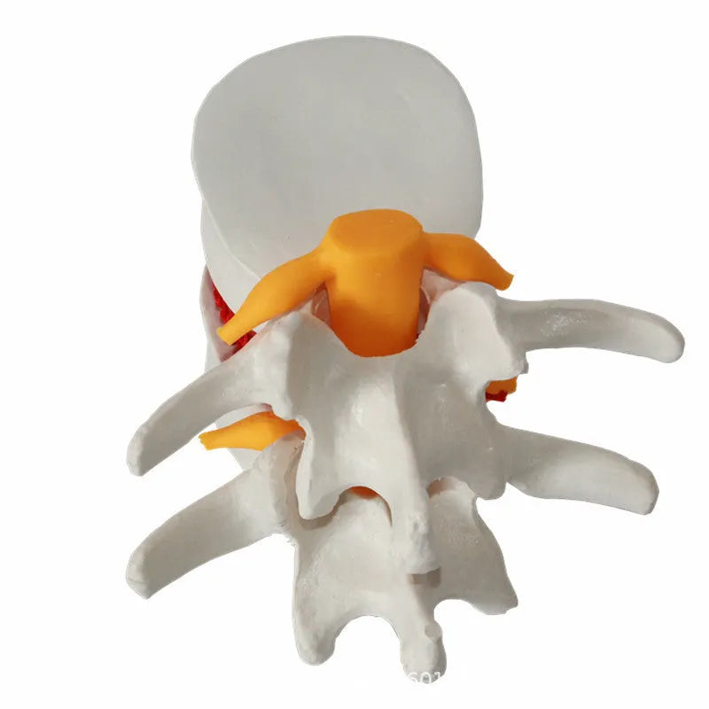 White PVC anatomical model of a lumbar spinal segment showing a herniated intervertebral disc.