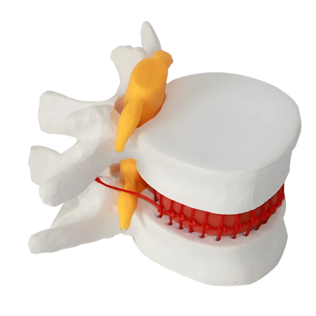 White PVC anatomical model of a lumbar spinal segment showing a herniated intervertebral disc.