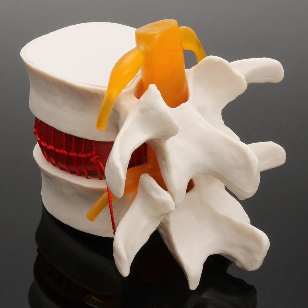 White PVC anatomical model of a lumbar spinal segment showing a herniated intervertebral disc.