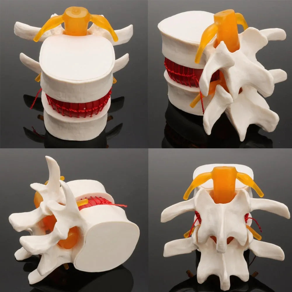 White PVC anatomical model of a lumbar spinal segment showing a herniated intervertebral disc.